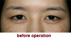 plastic-surgery-blepharoplasty